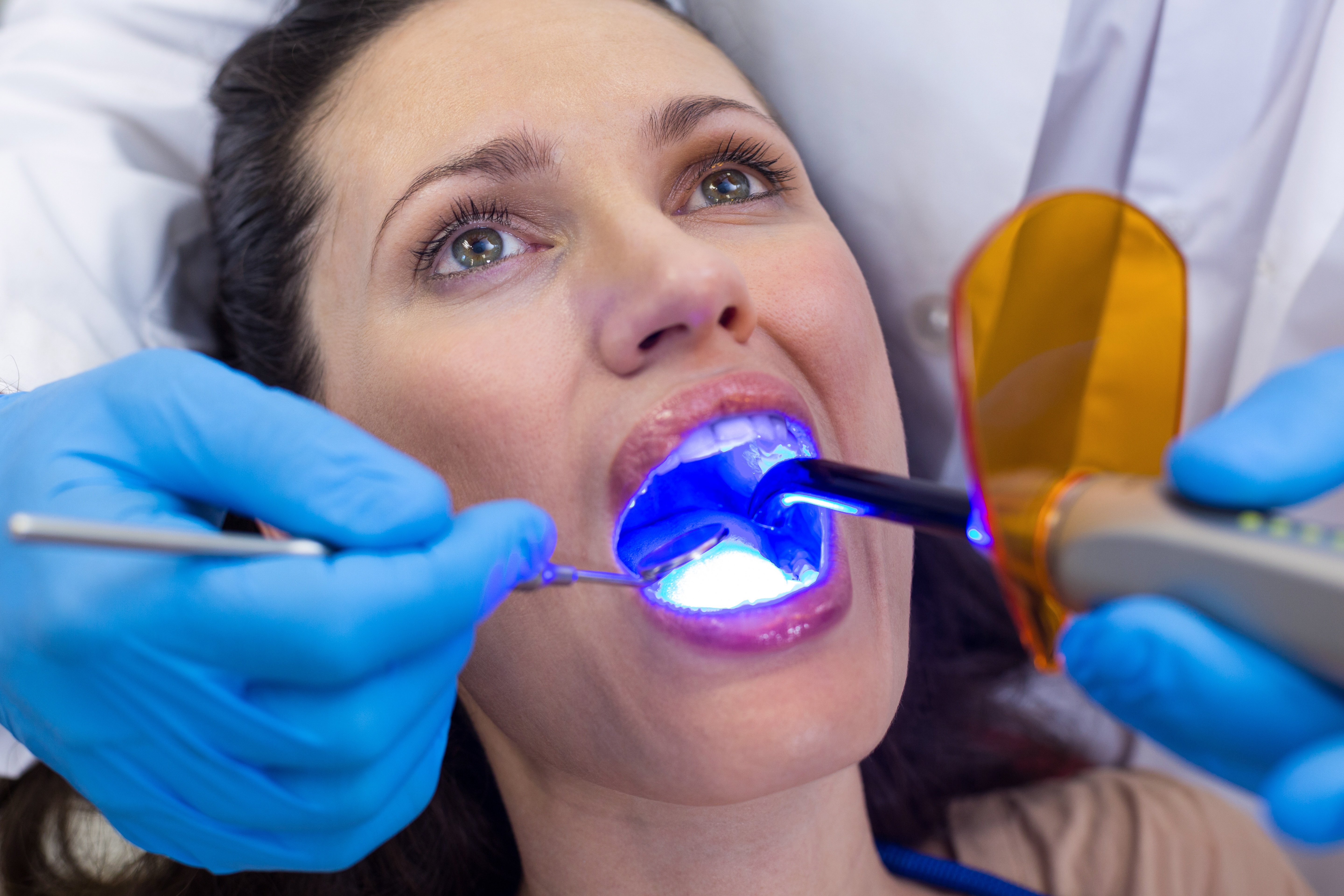 Clareamento dental a laser ou caseiro?